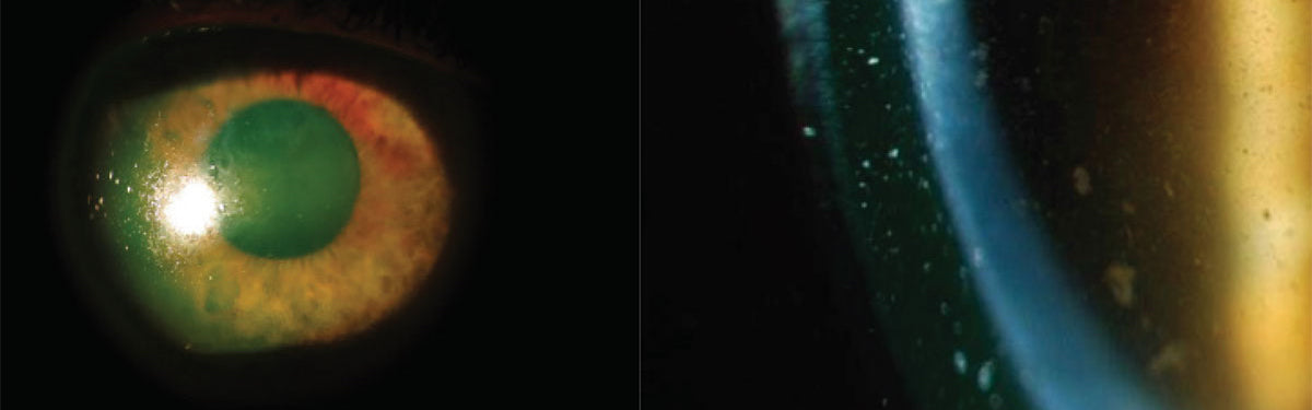 A case study showing how Tangible Hydra-PEG improves scleral contact lens fogging