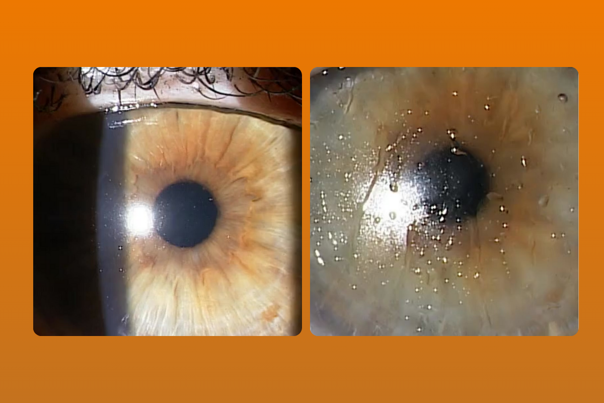 Troubleshooting Deposits on Hydra-PEG Coated Lenses